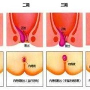 孕期肛门脱垂（肛门脱垂如何治疗）