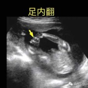 胎儿脚朝下（胎儿脚朝下）