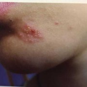 孕期单纯疱疹（孕期单纯疱疹）