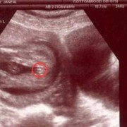 孕35周，孩子都六斤多了，应该怎么控制,6周大的胎儿图片b超图