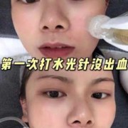 备孕期可以打水光针吗（备孕期可以打水光针吗女性）
