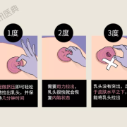 孕期乳头内陷怎么办？这是什么情况啊,孕期乳头内陷图片