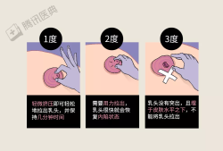 孕期乳头内陷怎么办？这是什么情况啊,孕期乳头内陷图片