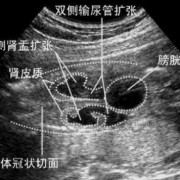 胎儿肾盂分离是男孩吗（胎儿肾盂分离是男孩吗）