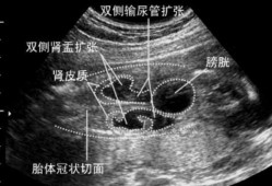 胎儿肾盂分离是男孩吗（胎儿肾盂分离是男孩吗）