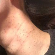 怀孕期间脖子上长肉丁（怀孕期间脖子上长肉丁怎么回事）