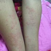 孕妇身上很痒是怎么回事,孕期身上痒怎么回事儿