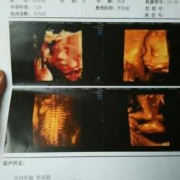 孕期三维彩超（三维彩超什么时候做）