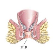 孕期痔疮肛裂（孕期痔疮肛裂）