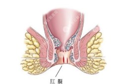 孕期痔疮肛裂（孕期痔疮肛裂）