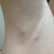 孕期腋下有味道（怀孕以后腋窝长了一个肉疙瘩是怎么回事）