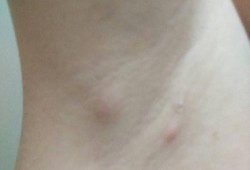 孕期腋下有味道（怀孕以后腋窝长了一个肉疙瘩是怎么回事）