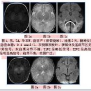 做核磁共振会影响孩子的大脑神经系统发育吗,胎儿发育神经是几周