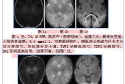 做核磁共振会影响孩子的大脑神经系统发育吗,胎儿发育神经是几周