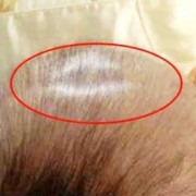 胎儿枕下前囟径（胎儿枕下前囟径的正常值是?）