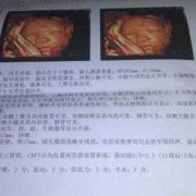 胎儿有强光点正常吗（四维彩超显示胎儿左心室有强光点什么意思）