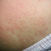胎毒是如何产生的,孕期湿疹是因为胎毒吗怎么治疗