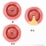 孕期阴道充血