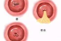 孕期阴道充血