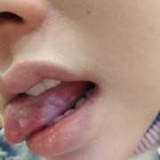 孕期舌头疼怎么办（孕期舌头疼怎么办快速缓解）