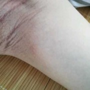 孕期腋下变黑（孕期腋下变黑）