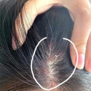 孕期头皮发痒（孕期头皮发痒怎么回事）