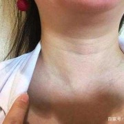 胎儿颈部厚怎么造成的（九个月的宝宝脖子手心脚发热怎么回事）