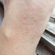孕期手脚发痒（孕期手脚发痒怎么回事）