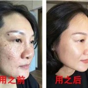 孕期能去斑吗（孕妇可以用维生素e擦脸祛斑吗）