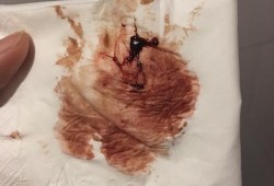孕妇呕吐出血是怎么回事,孕期经期出血怎么回事