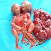 四个月引产的胎儿图片（四个月怀孕引产下来的婴儿形状能分辨出男女吗）