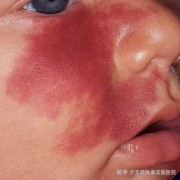 胎儿红色胎记（胎儿红色胎记）