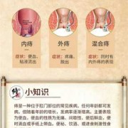 孕期  痔疮（孕期长痔疮怎么治疗）