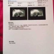 孕期出血宫腔有激液怎么办,孕期出血了