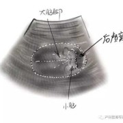 后颅窝池高界值是什么意思,胎儿后颅窝池宽是什么原因造成的