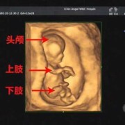 三维胎儿图（二维三维四维空间区别）