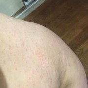 孕期湿疹什么样（请问大家孕妇湿疹怎么止痒啊）