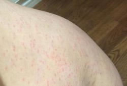 孕期湿疹什么样（请问大家孕妇湿疹怎么止痒啊）