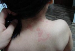 风疹对胎儿的影响（风疹会导致胎儿哪些畸形）