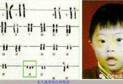 胎儿怎样排除是唐氏儿（胎儿怎样排除是唐氏儿呢）