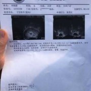 怀孕50天，胎儿心跳搏动113次/分，正常吗,听胎儿心脏需要憋尿吗