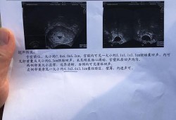 怀孕50天，胎儿心跳搏动113次/分，正常吗,听胎儿心脏需要憋尿吗