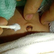 生完孩子后肚脐眼凹进去变成一个大洞洞了怎么回事,孕期肚脐凹陷是男孩女孩