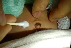 生完孩子后肚脐眼凹进去变成一个大洞洞了怎么回事,孕期肚脐凹陷是男孩女孩