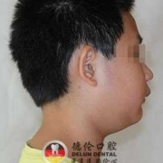 胎儿小下颌畸形图片（下颌后缩是怎么回事）