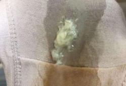 孕期念珠菌（怀孕得了霉菌怎么办）