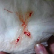 孕期鼻涕有血丝（孕期鼻涕有血丝怎么回事）