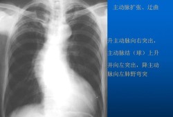 孕妇拍了x光怎么办，一次x线对孕早期有什么影响,孕期x线检查哪个部位对胎儿影响较大