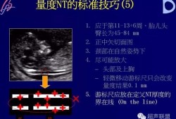 颈后透明层厚度多大正常,胎儿颈项透明层厚度正常值