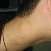 脖子囊肿是什么原因,胎儿颈部囊肿